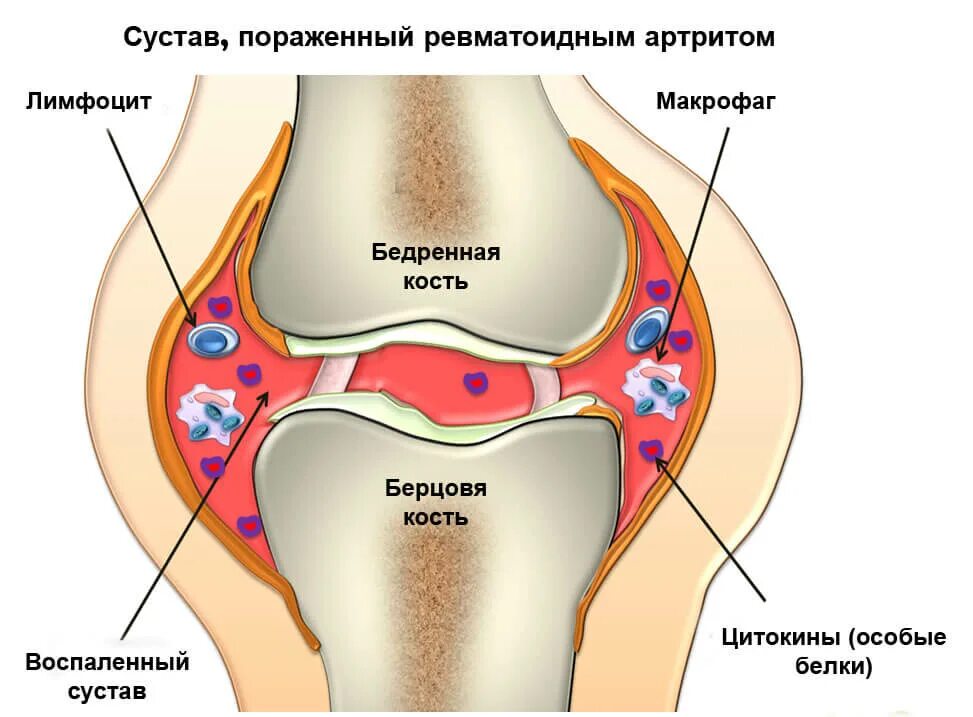 Артрит что это. Ревматоидный артрит поражение суставов. Ревматоидный артрит суставные проявления.