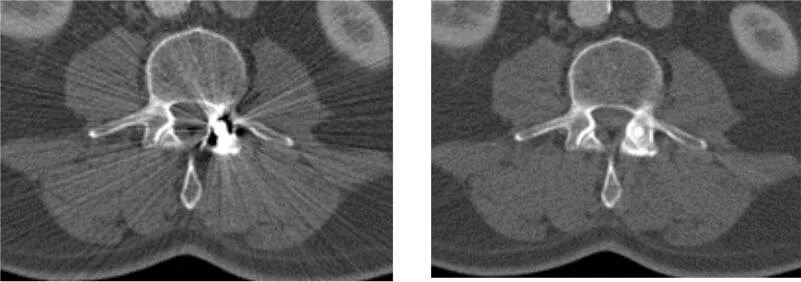 Артефакты на кт. Металлические артефакты на кт. Артефакты движения на мрт. Металлические артефакты на кт. Металлические артефакты на кт.