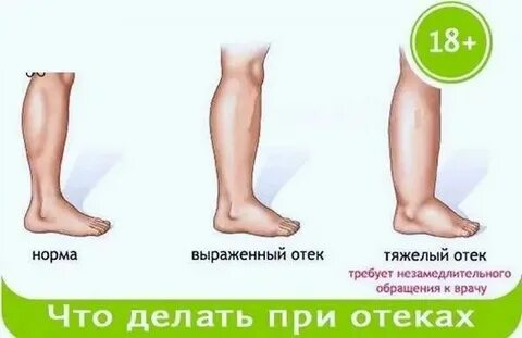 Что делать если отек