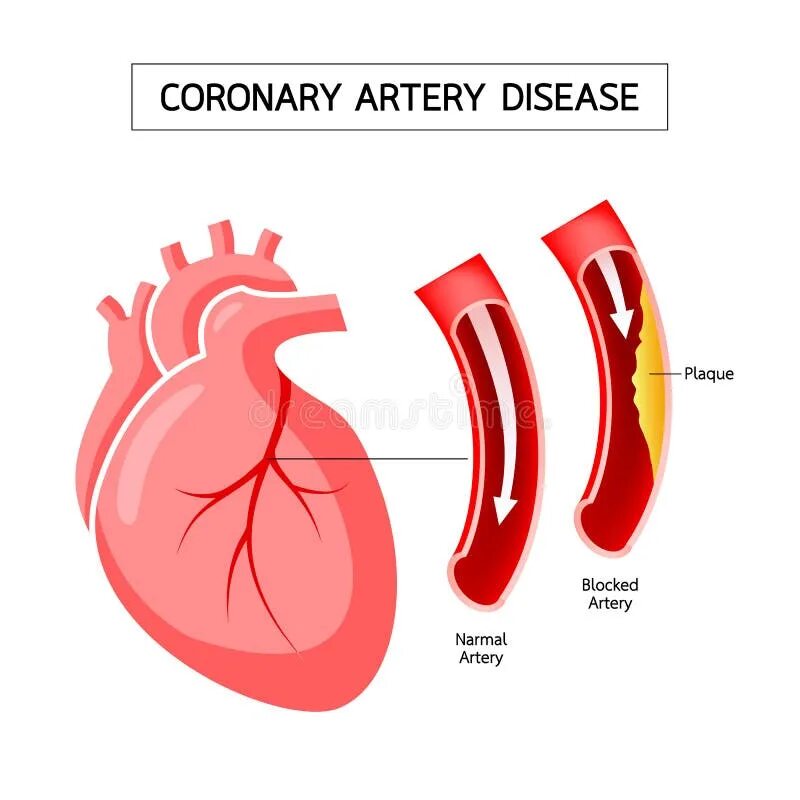 Coronary heart disease. Coronary heart disease. Ишемическая болезнь сердца. Coronary heart disease. Ишемическая болезнь сердца инфографика.
