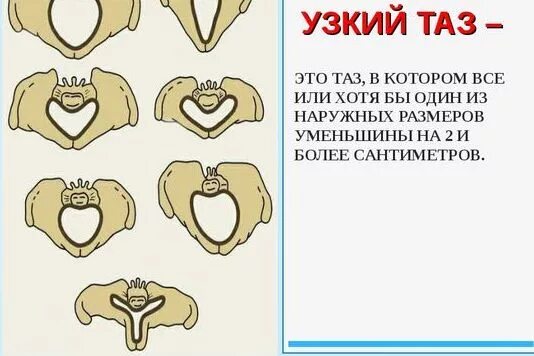 Критерии узкого таза. Клинический узкий таз. 2. Узкий таз форум. Анатомический узкий таз.