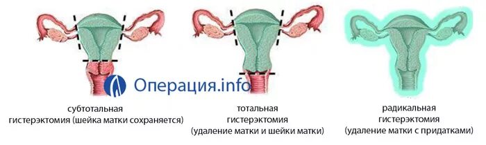 Удаление матки и половая жизнь. Экстирпация матки (тотальная гистерэктомия). Лапароскопия тотальная гистерэктомия. Ампутация матки ход операции.