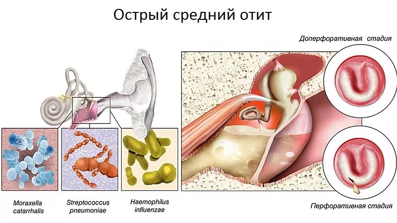 Острый Гнойный средний отит этиология. Острый средний отит доперфоративная. Гнойный средний отит уха. Острый средний отит доперфоративная стадия. Острый гнойный средний отит стадии