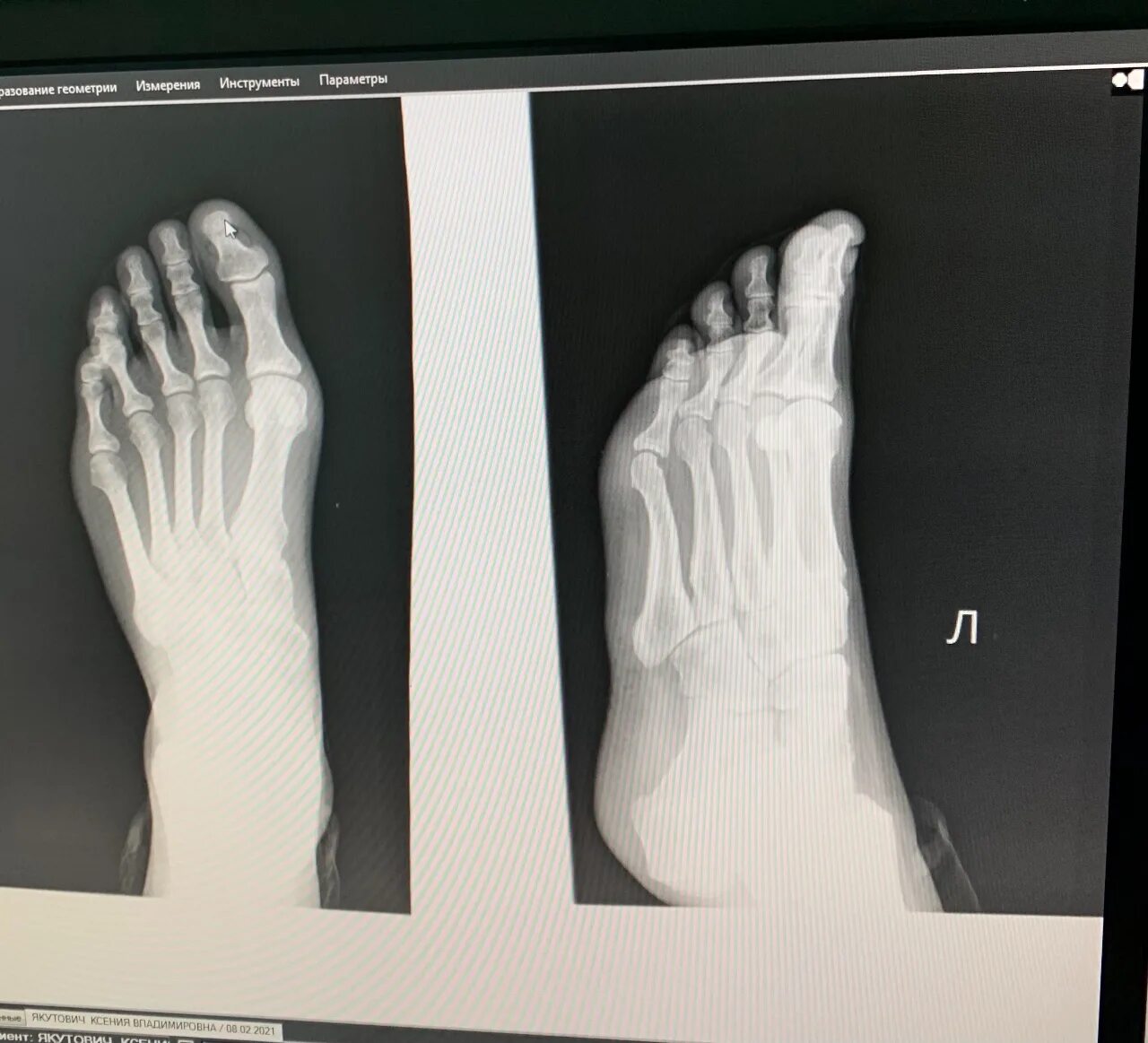 Экзостоз 1 пальца стопы на рентгене. Экзостоз ногтевой фаланги 1 пальца стопы. Экзостоз пальца стопы рентген. Ногтевая фаланга ноги