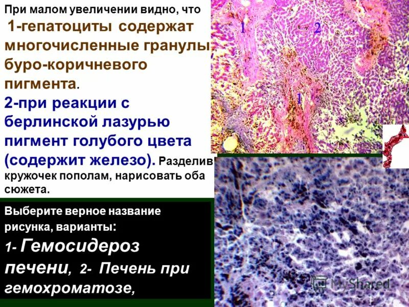 Печень микропрепарат описание. Гемосидероз печени микропрепарат. Гемосидероз и гемохроматоз. Гемосидероз печени макропрепарат. Этиология гемосидероза печени.