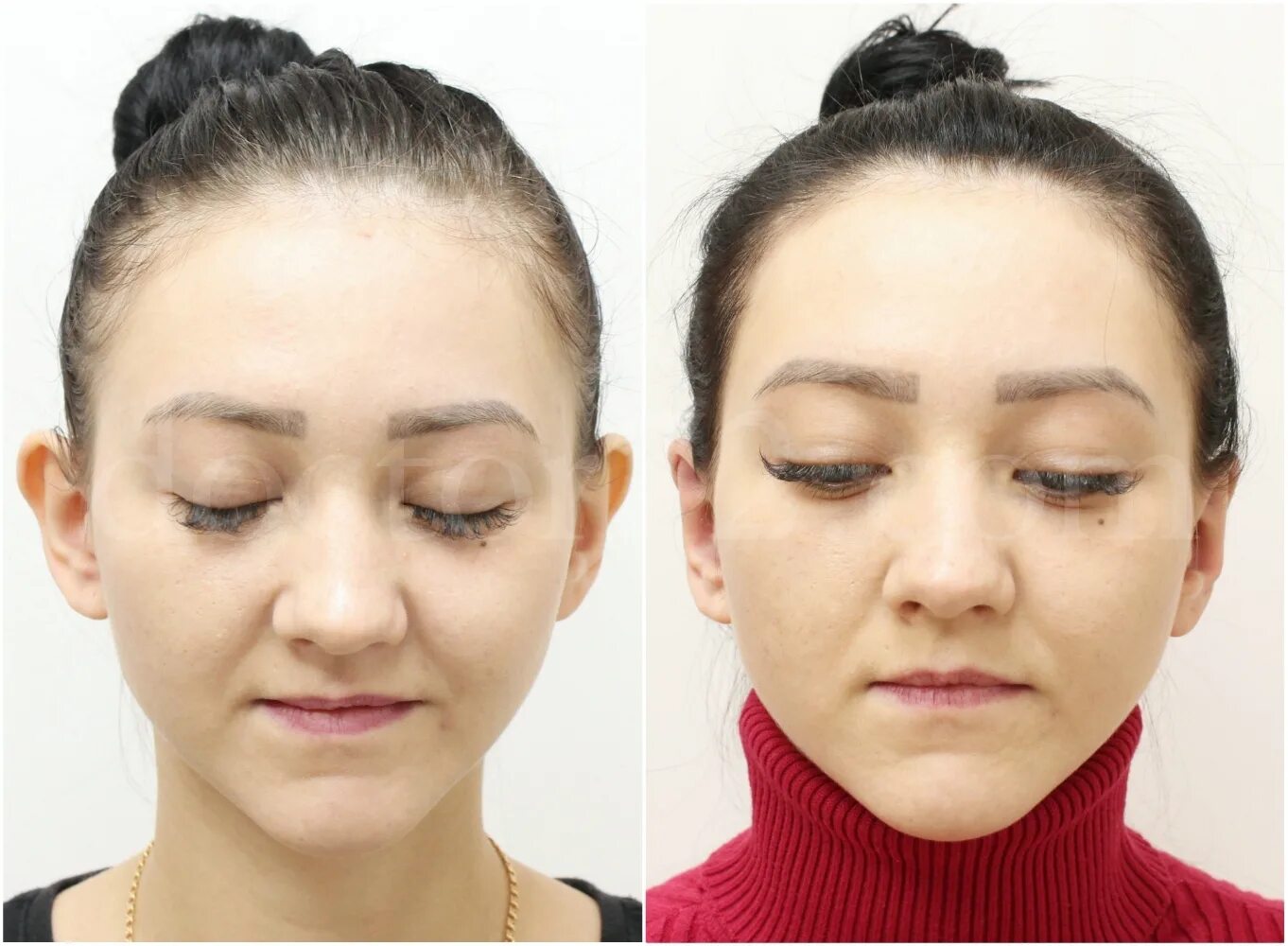 отопластика видео