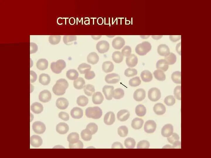 Стоматоциты эритроциты. Стоматоцитоз эритроцитов. Наследственный стоматоцитоз. Стоматоциты патология. Эхиноциты