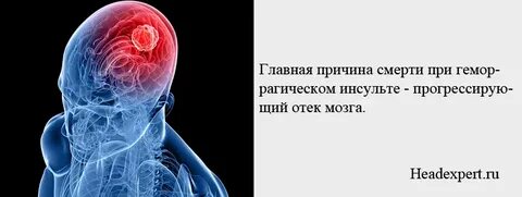 Отек мозга при инсульте