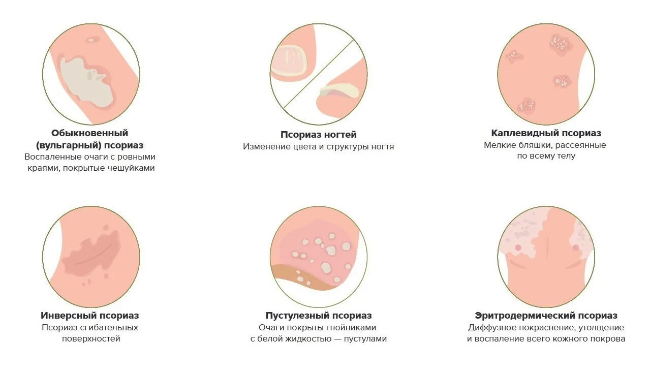 Клинические формы псориаза. Атипичные клинические формы псориаза. Каплевидный псориаз симптомы. Стадии каплевидного псориаза.