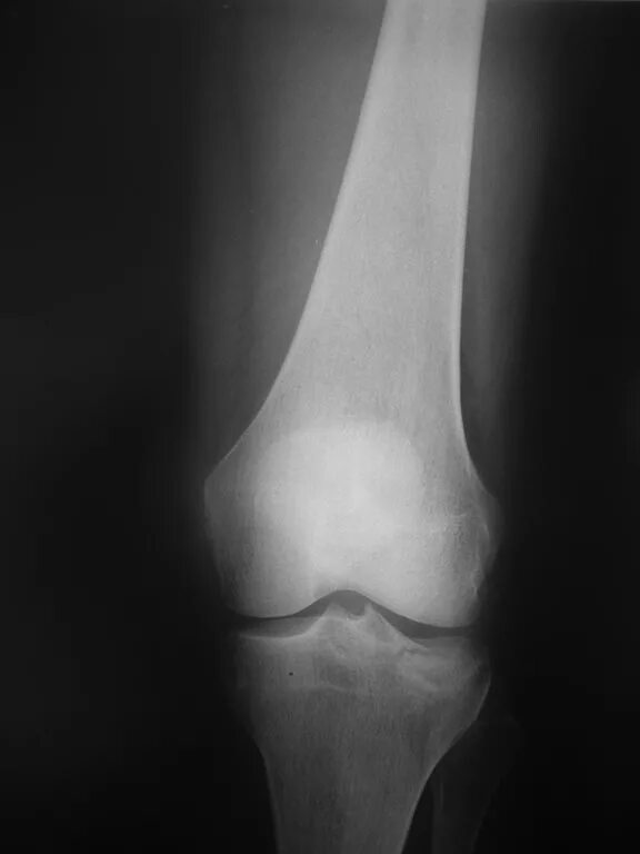 мыщелок большой берцовой кости перелом