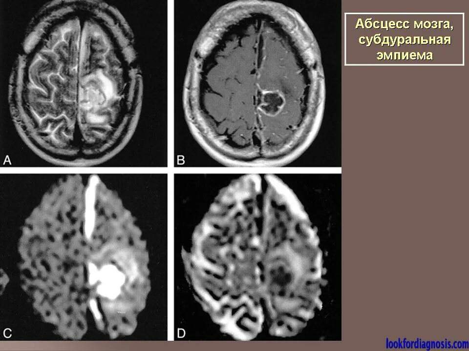 Абсцесс мозга. Субдуральная эмпиема кт. Субдуральная эмпиема кт мрт. Эпидуральный абсцесс головного мозга кт. Субдуральная эмпиема головного мозга на кт.