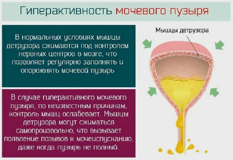 Болезненное мочеиспускание причины. Гиперактивный мочевой пузырь. Синдром гиперактивного мочевого пузыря. Гиперактивный мочевой пузырь у женщин. Симптомы гиперактивного мочевого пузыря.