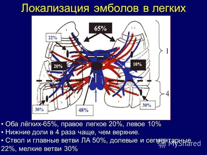 Ветви в легких. Локализация эмболов. Схема передвижения эмболов. Ветви легких. Схема расположения эмболов в языке легком перепонке.