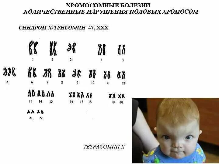 Трипло х. Синдром Патау (трисомия по 13-й хромосоме). Синдром трисомии х хромосомы. Кариотип больного с синдромом Патау. Нарушения кариотипа структура хромосом.