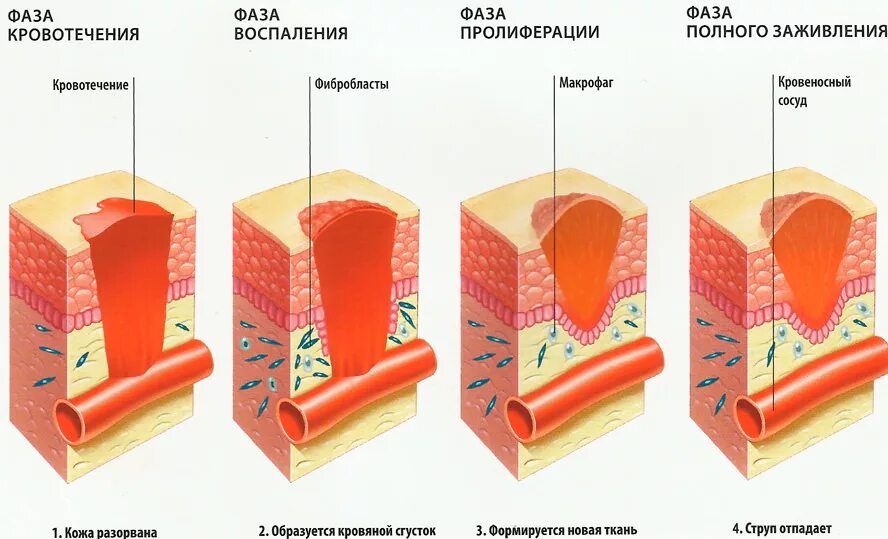 Распад кожи. Заживления РАН грануляция. Фазы заживления ожоговых РАН. Кожа этапы заживления РАН. Грануляция тканей этапы заживления РАН.