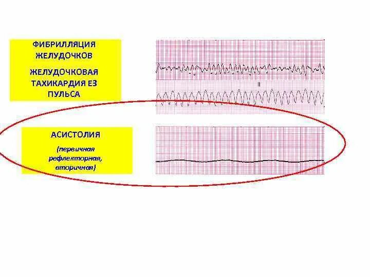 Асистолия что это. Асистолия на ЭКГ. Асистолия желудочков. Асистолия желудочков на ЭКГ. Фибрилляция желудочков и асистолия презентация.