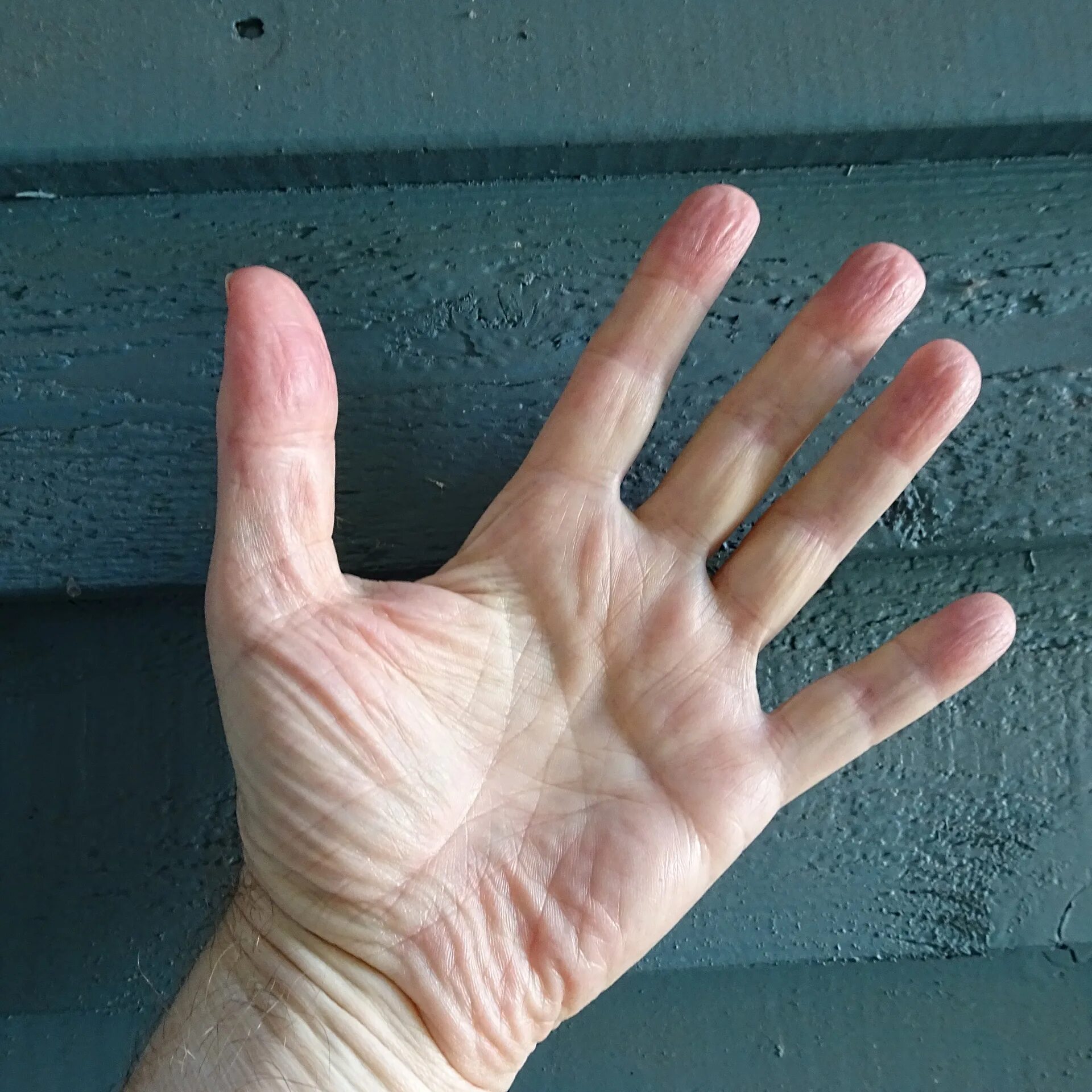 Акроцианоз синдром Рейно. Ладони. Левая рука темнее правой