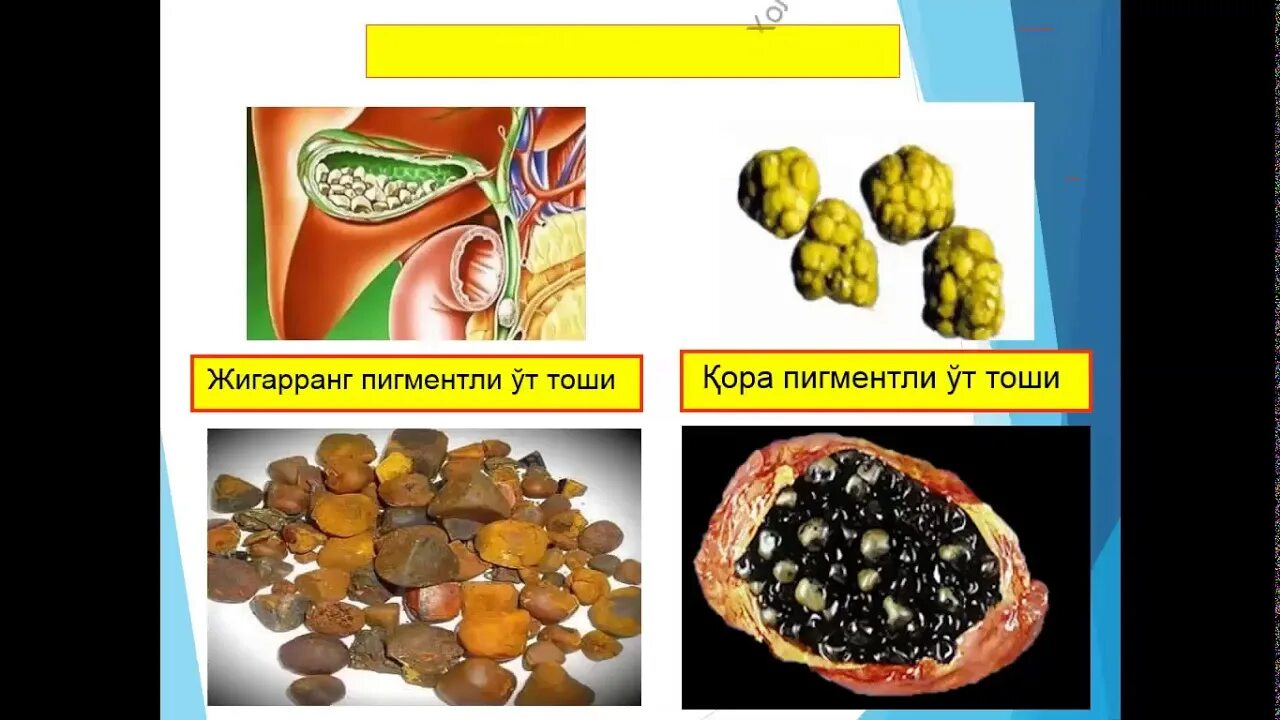 Острый калькулезный холецистит и желчекаменная болезнь. ЖКБ острый калькулезный холецистит. Камни желчного пузыря патанатомия. Калькулезный холецистит макропрепарат. Отвар камни в желчном