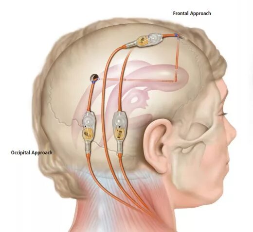 Установка шунта. Вентрикуло-перитонеальное шунт. Шунт Medtronic вентрикулоперитонеальный. Шунт ВПШ вентрикуло-перитонеальный. Шунтирование желудочков мозга.