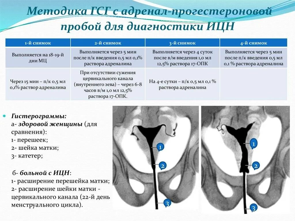 Истмико-цервикальная недостаточность по УЗИ. ИЦН клинические проявления. Классификация ИЦН. Швы при ицн