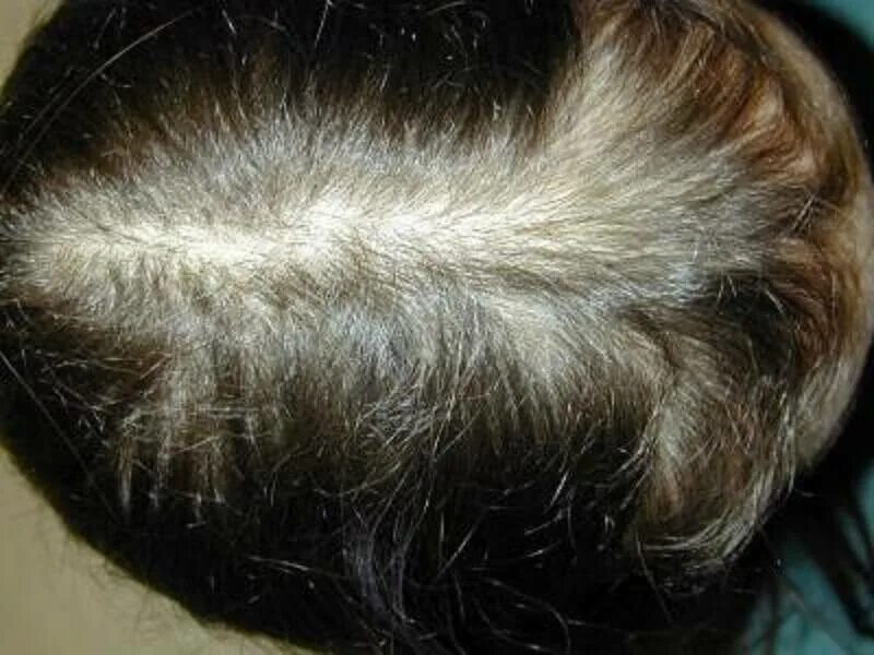 Зуд головы и выпадение волос причины