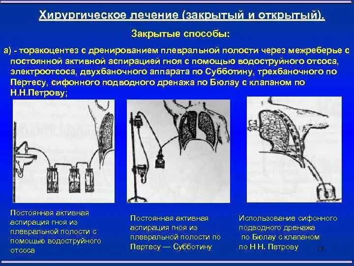 Пункция и дренирование плевральной полости торакоцентез. Пассивное дренирование Бюлау. Дренирование при эмпиеме плевры методика.