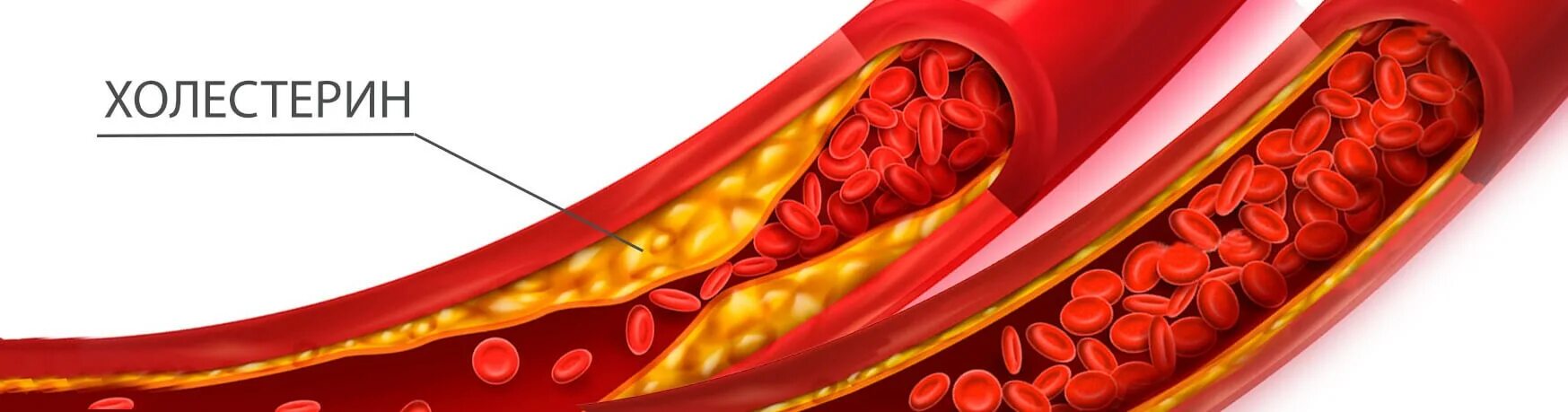 Влияние холестерина в крови. Холестт. Холестерин. Высокий уровень холестерина. Борьба с холестерином.