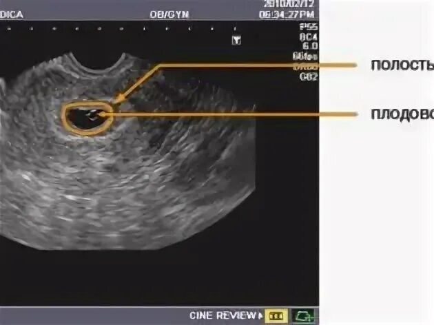 Узи после криопереноса. УЗИ при подсадке эмбрионов.