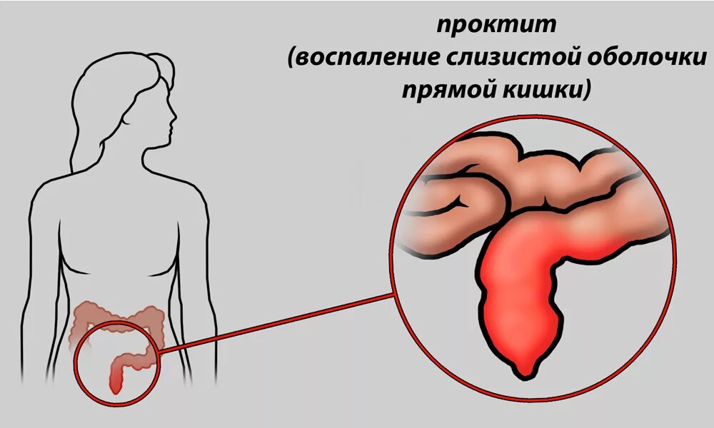 Воспаление заднего. Воспаление прямой кишки (проктит). эритематозный проктит. воспаление слизистых прямой кишки. воспаление слизистой прямой кишки.