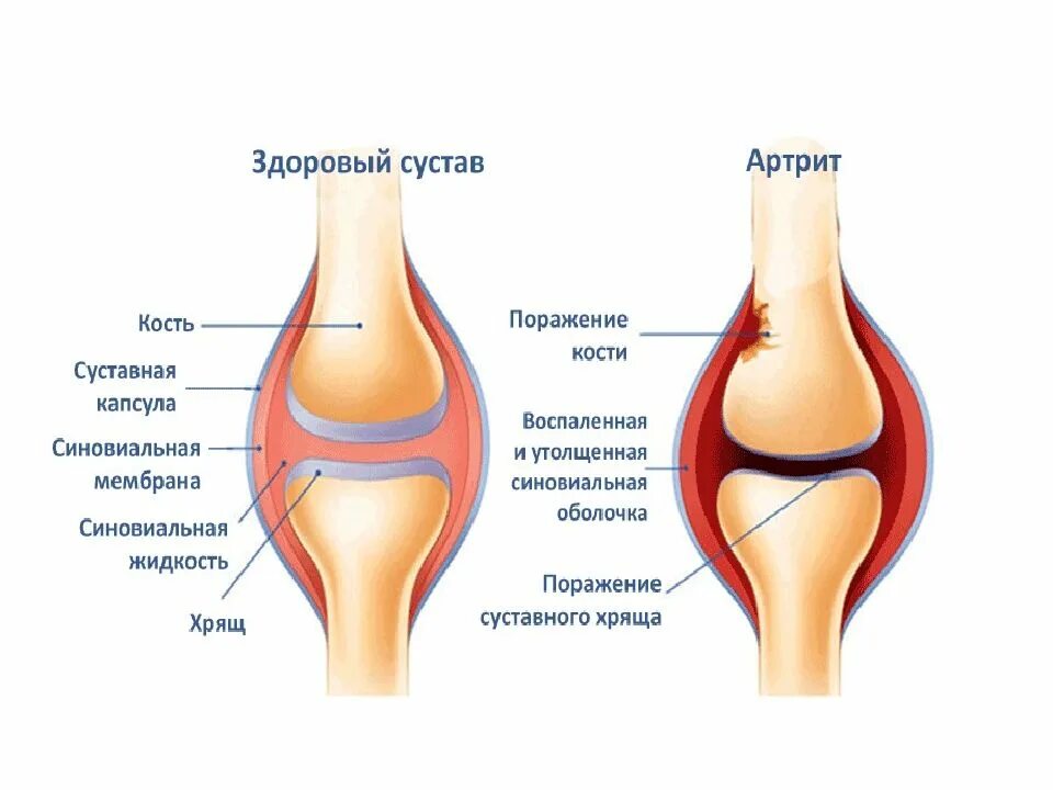 Болезнь суставов коленей. Ревматоидный артрит классификация коленный сустав. Строение сустава. Суставная капсула коленного сустава. Строение сустава человека.