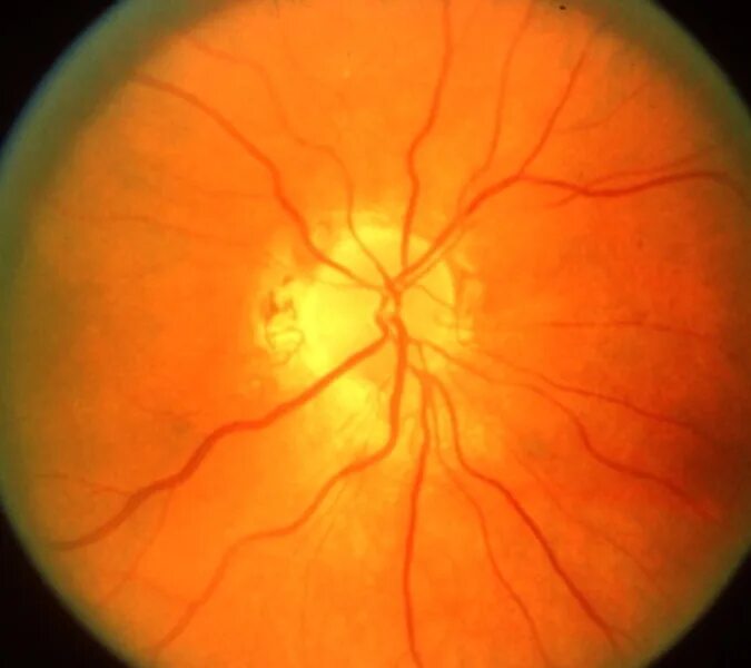 Тип зрительного нерва. Атрофия зрительного нерва Лебера. Наследственная оптическая нейропатия Лебера. Атрофия зрительного нерва Лебера генетика.