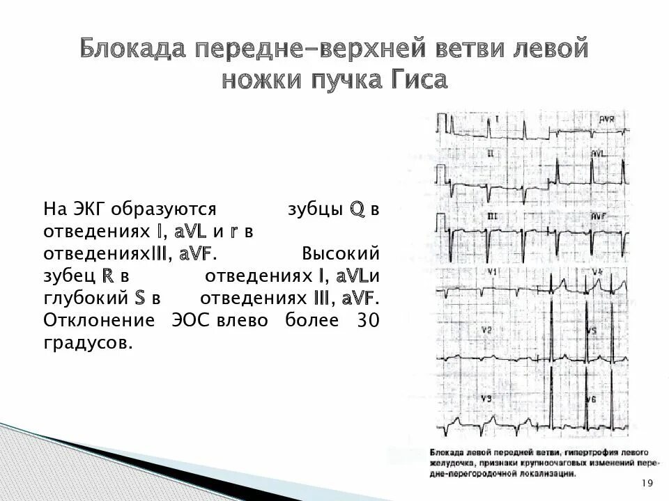 Блокада левой ножки п гиса. Блокада передней ветви ЛНПГ на ЭКГ. Неполная блокада передней ветви ЛНПГ на ЭКГ. Блокада передней ветви пучка Гиса на ЭКГ. Блокада левой ножки пучка Гиса на ЭКГ.