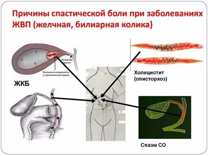 Приступ после удаления желчного пузыря