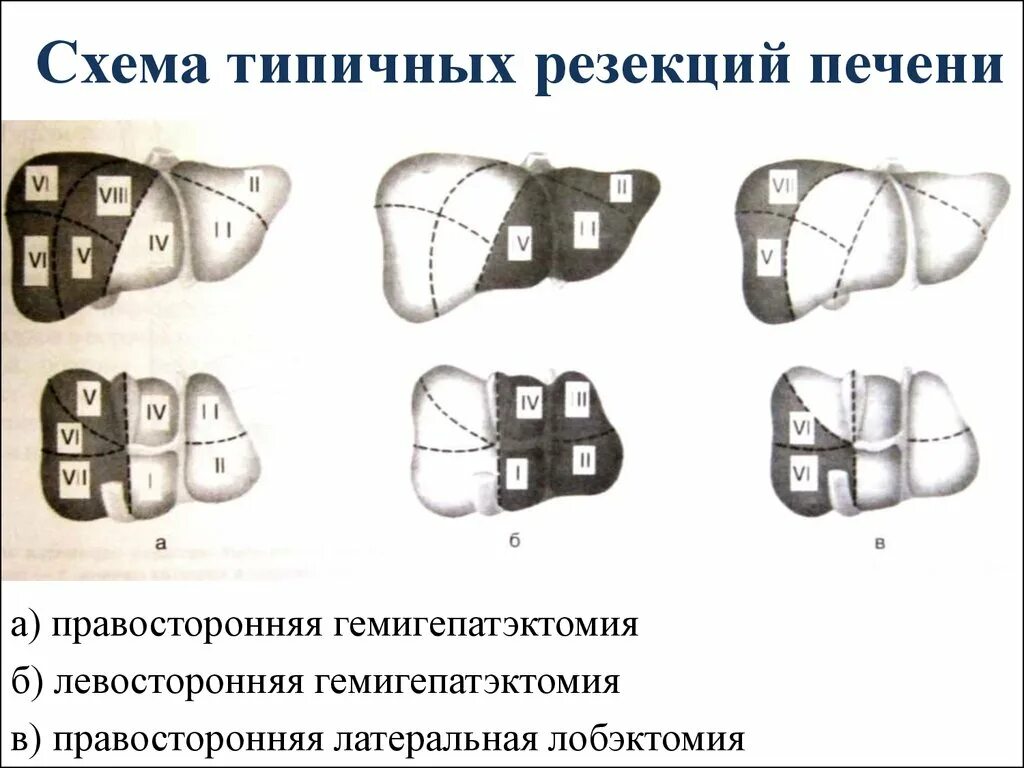 Операция по удалению печени. Резекции печени типичные и атипичные. Типичная резекция печени схема. Сегменты печени лобэктомия. Анатомическая (типичная) и атипичная резекция печени.