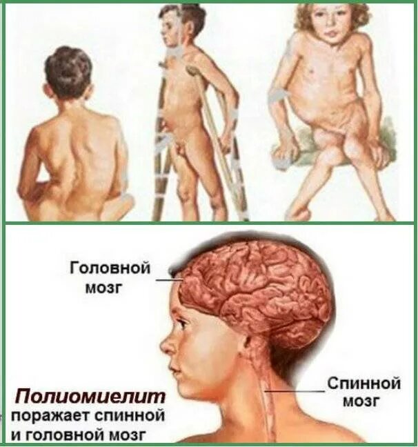 Паралитическая форма полиомиелита. Полиомиелит симптомы неврология. Полиомиелит у детей презентация. Бульбарная форма полиомиелита. Вирусные заболевания человека полиомиелит.
