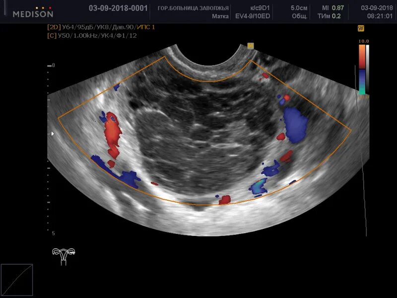 Киста гартнерова хода на УЗИ. Цветное допплеровское картирование яичников. Киста размеры для операции