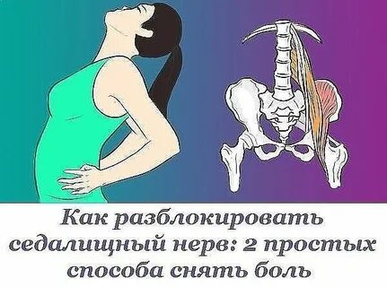 Защемление седалищного при беременности