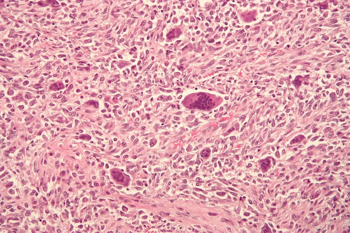 Sarcoma horror