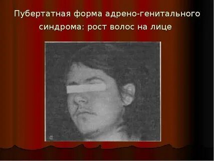 Пубертатный синдром