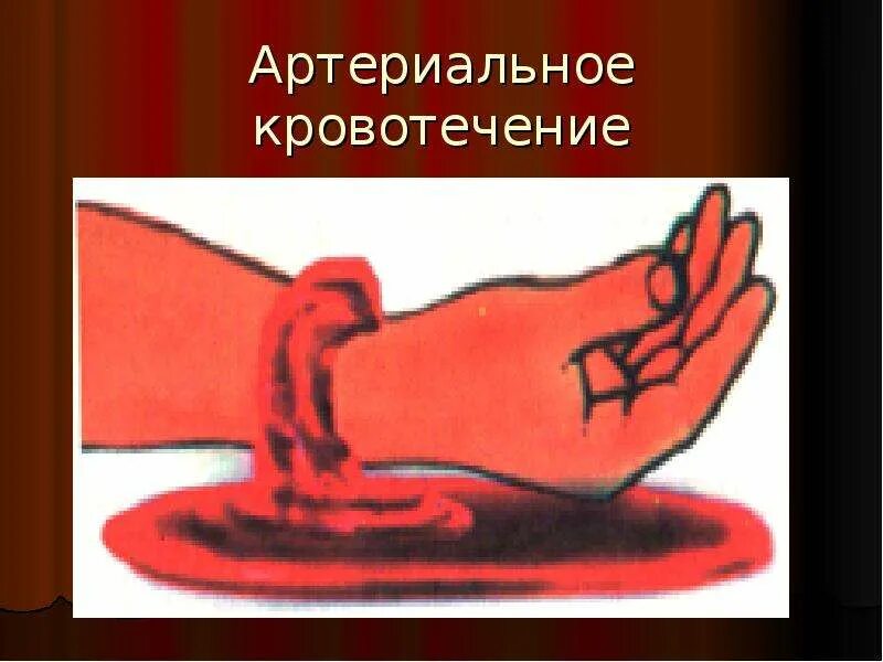 Кровотечение в первой половине. Артериальное кровотечение. артериальное кровотечение рисунок.