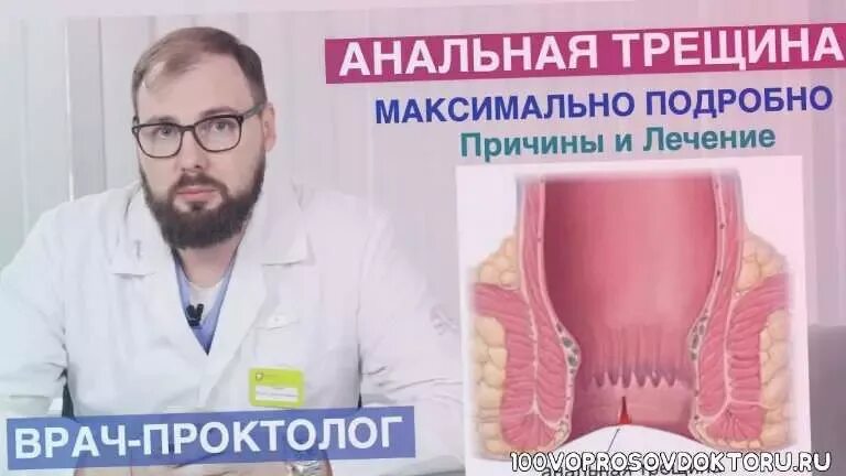 Как выглядит трещина в заднем проходе