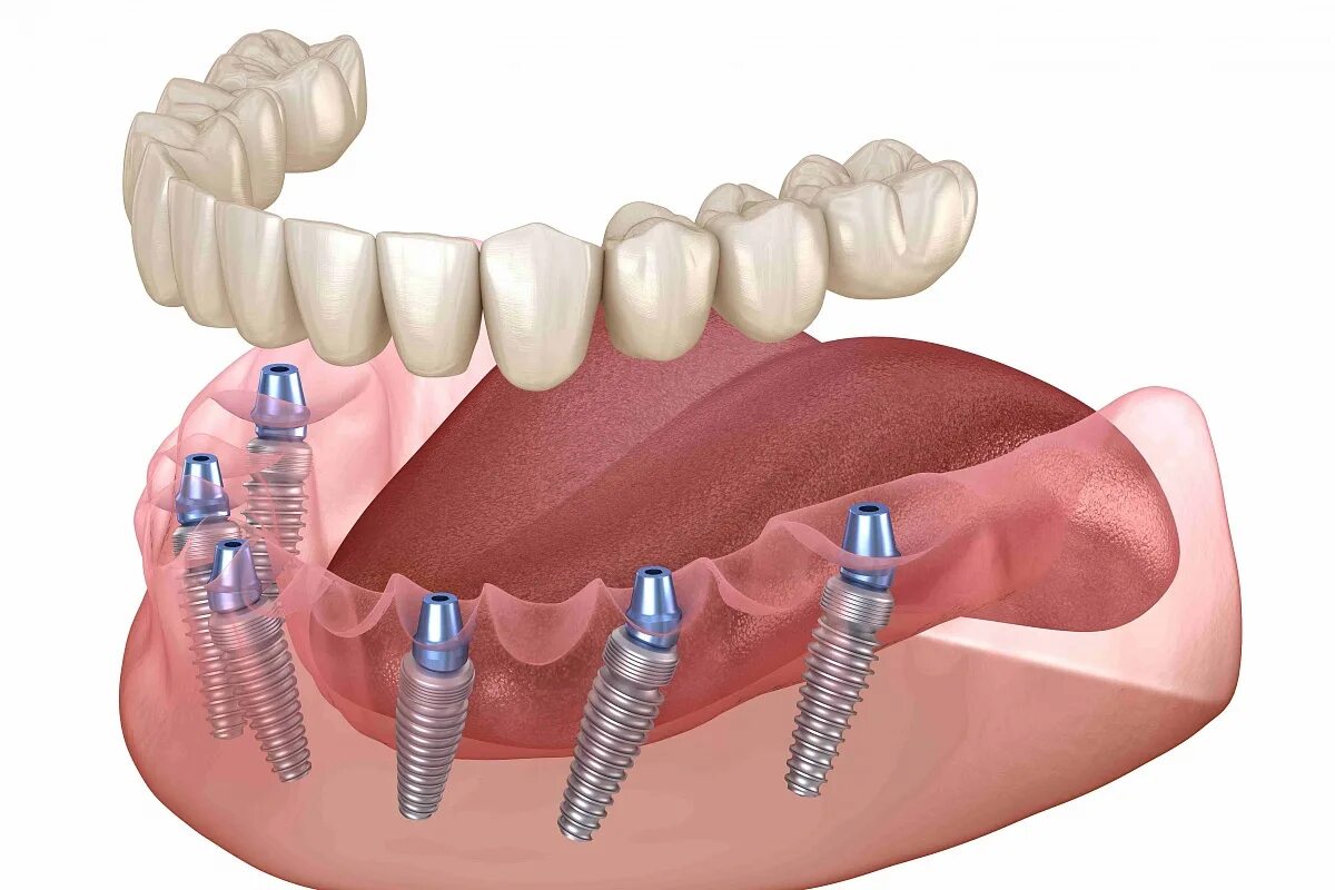 All on 6 цена. Полный съемный протез на имплантатах.