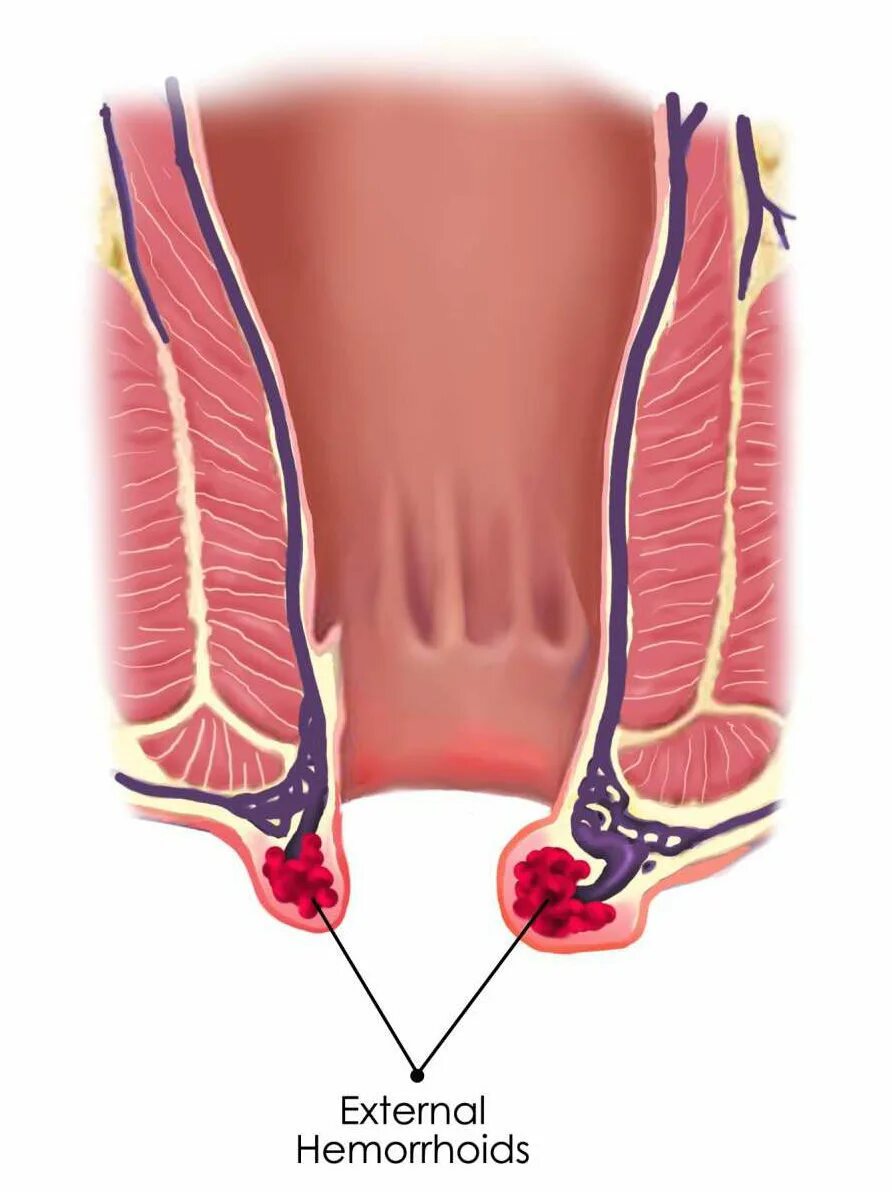 Ощущение трещина. Тромбированный наружный геморроидальный узел. Тромбированый наружний ге. Внешние геморроидальные узлы стадии.