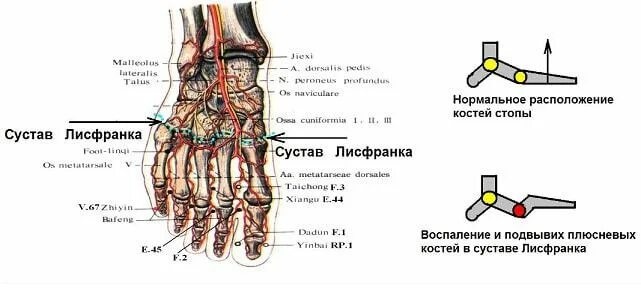 сустав шапарова и лисфранка. вычленение стопы в суставе лисфранка. сустав шопара и лисфранка. лисфранка сустав стопы. подвывих в таранно ладьевидном суставе.