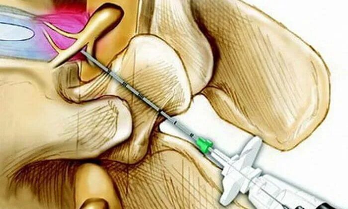 Блокада грыжи цена. Эпидуральная блокада грыжи. Эпидуральная блокада поясничного отдела терапия. Блокада грыжи позвоночника. Паравертебральные блокады поясничного отдела.