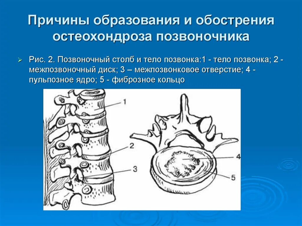 После обострения остеохондроза