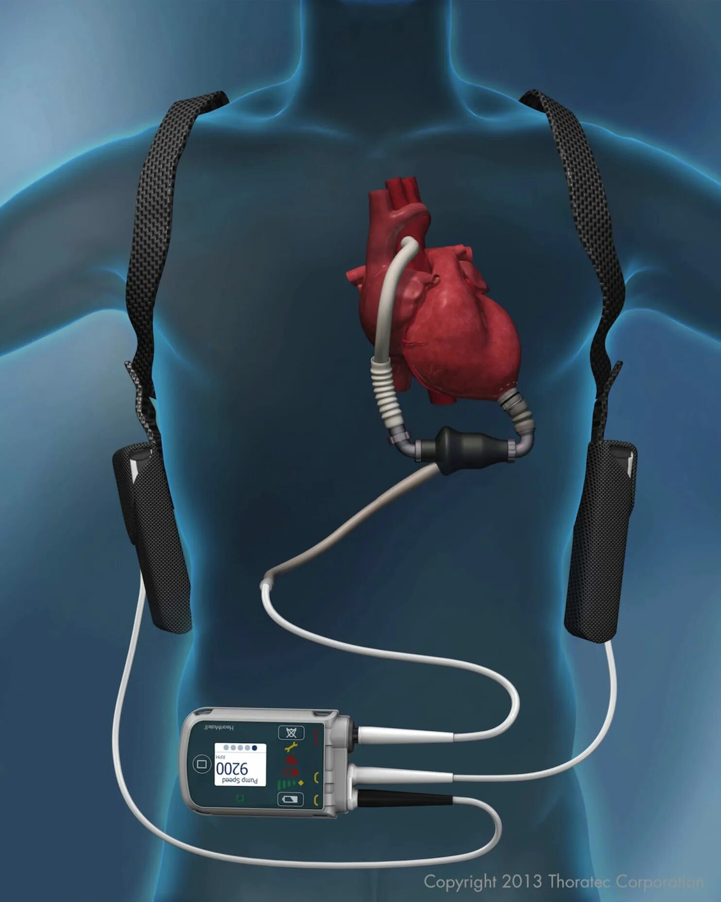 LVAD HEARTMATE 3. Система HEARTMATE III.