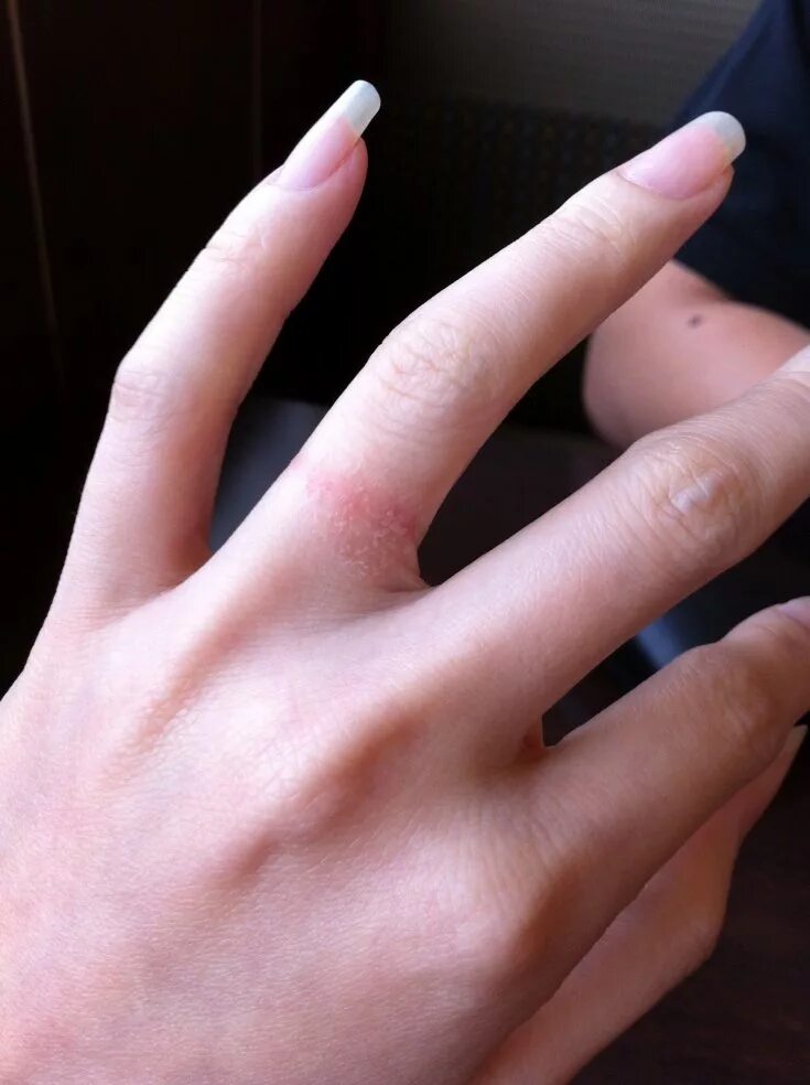 Потемнения от кольца. Под кольцом. Неснимаемое кольцо на пальце. Палец под обручальным кольцом. Перстень на безымянном пальце.