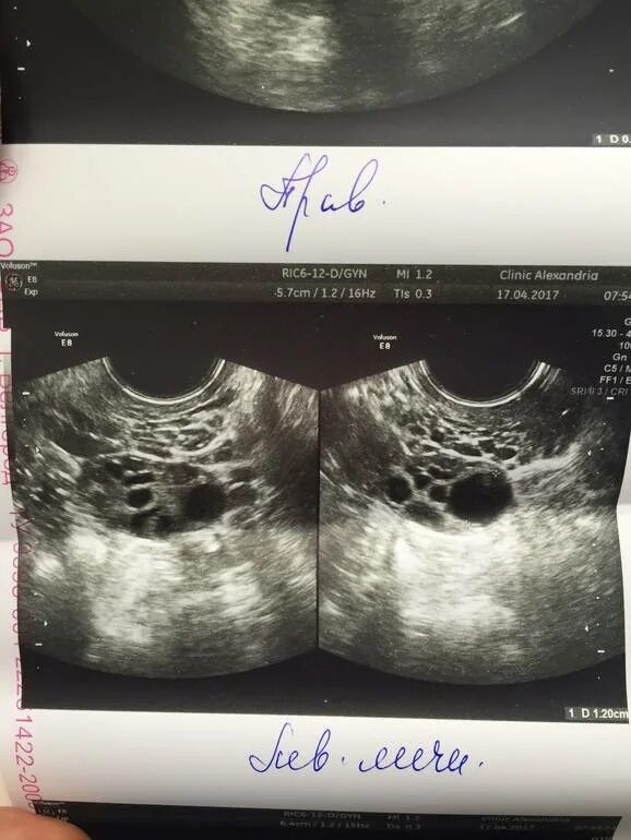 Узи мониторинг фолликулогенеза. Овуляторный цикл желтое тело в правом яичнике. Узи яичников доминантный фолликул. Как выглядит фолликул после овуляции на узи. Фолликулы после овуляции.