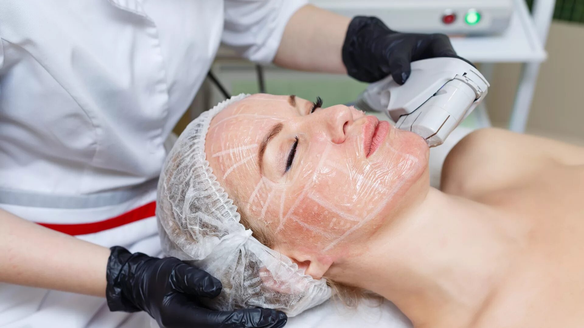 стоит ли делать смас лифтинг. ультразвуковой smas лифтинг ulthera,. альтера ультразвуковой лифтинг. ультразвуковой смас лифтинг. стоит ли делать смас лифтинг.